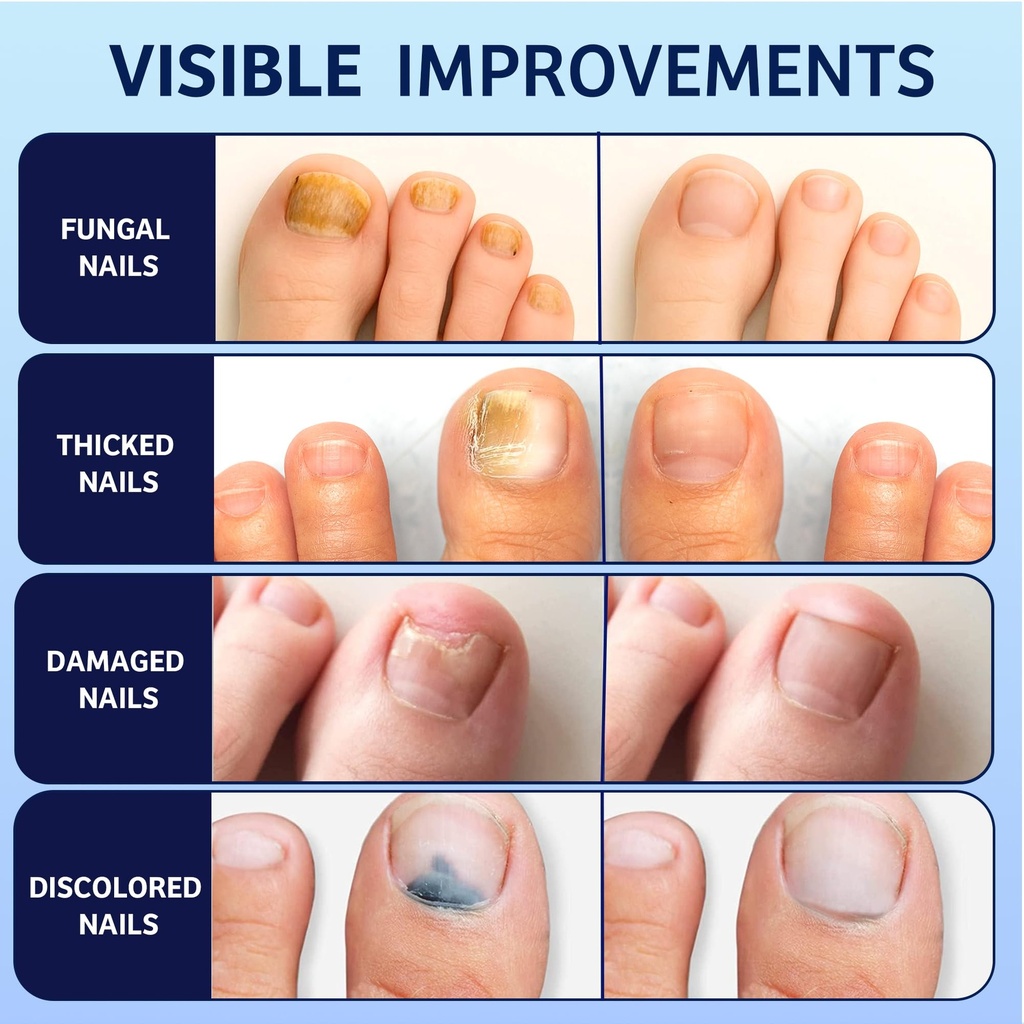 meoly-toenail-fungus-treatment-30-undecy-5.jpg