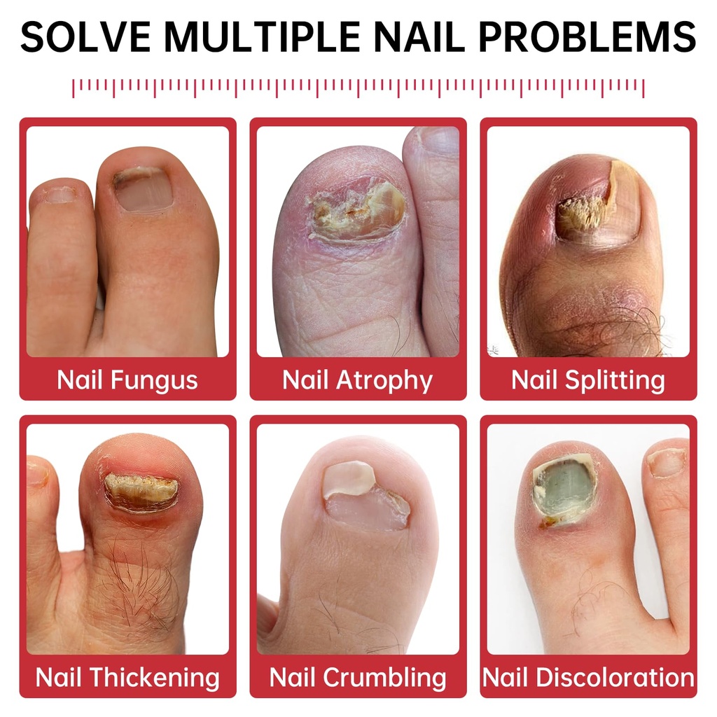 nail-fungus-treatment-extra-strength-1-t-2.jpg