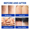 hermon-antifungal-ringworm-cream-for-hum-2.jpg