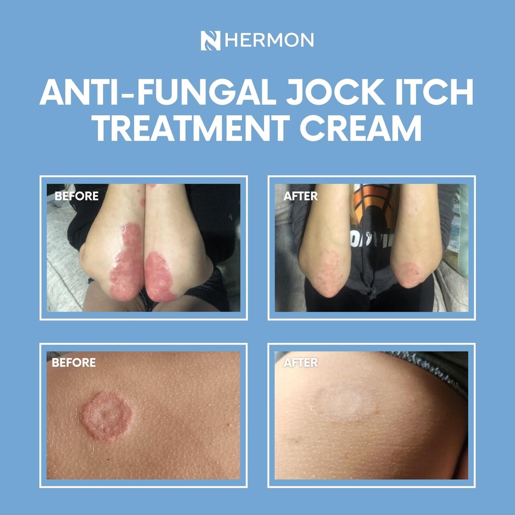 hermon-jock-itch-cream-ringworm-treatmen-6.jpg