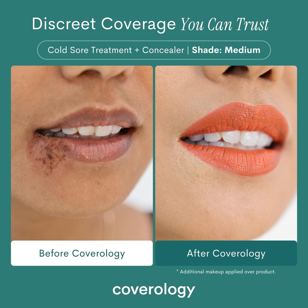 coverology-cold-sore-treatment-cold-sore-3.jpg