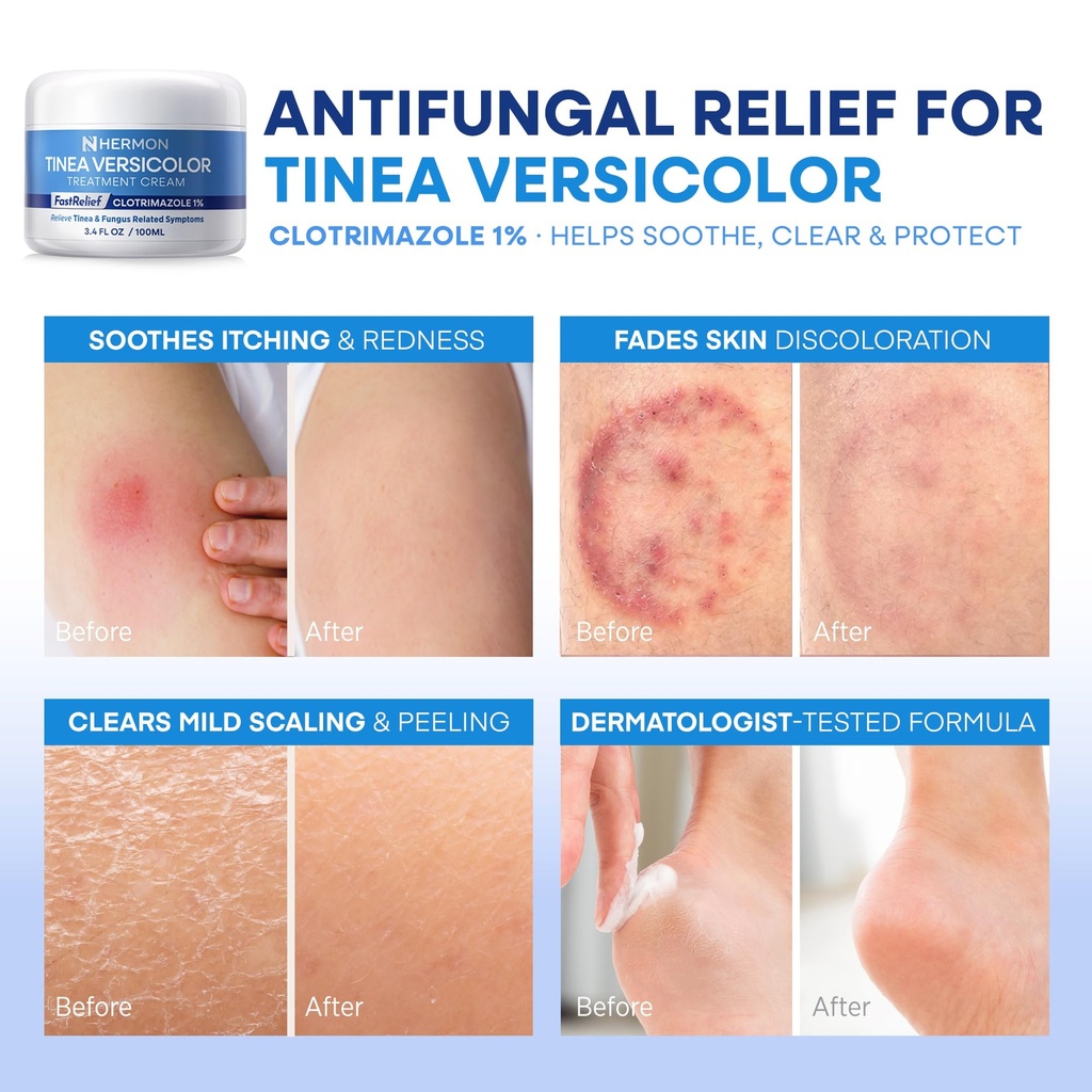 hermon-tinea-versicolor-treatment-cream--6.jpg