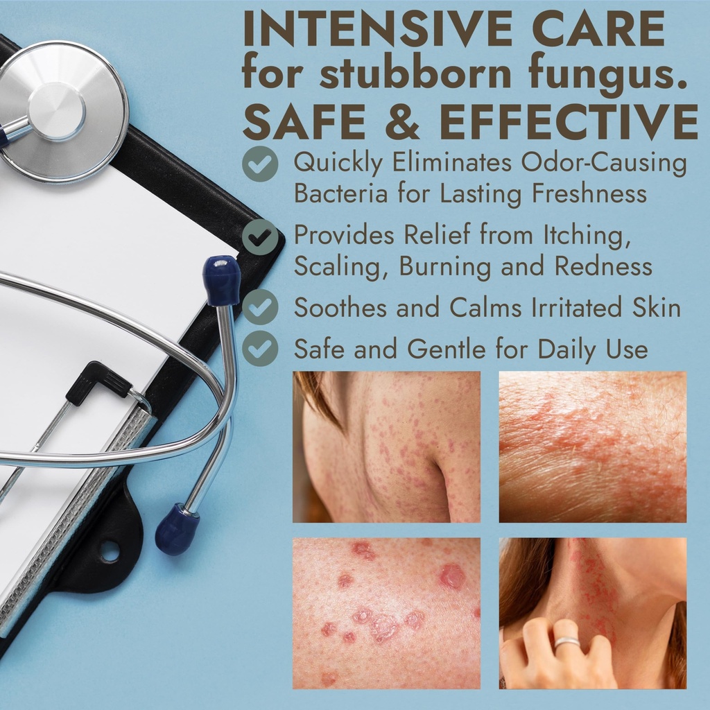 tinea-versicolor-treatment-antifungal-cr-4.jpg