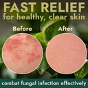 tinea-versicolor-treatment-antifungal-cr-5.jpg