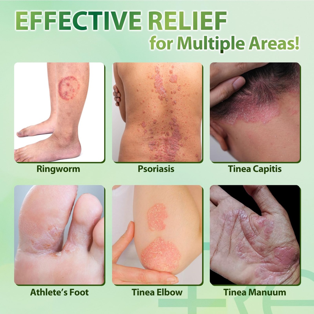 recuren-plus-jock-itch-antifungal-skin-c-71A1B7VIqwL.jpg