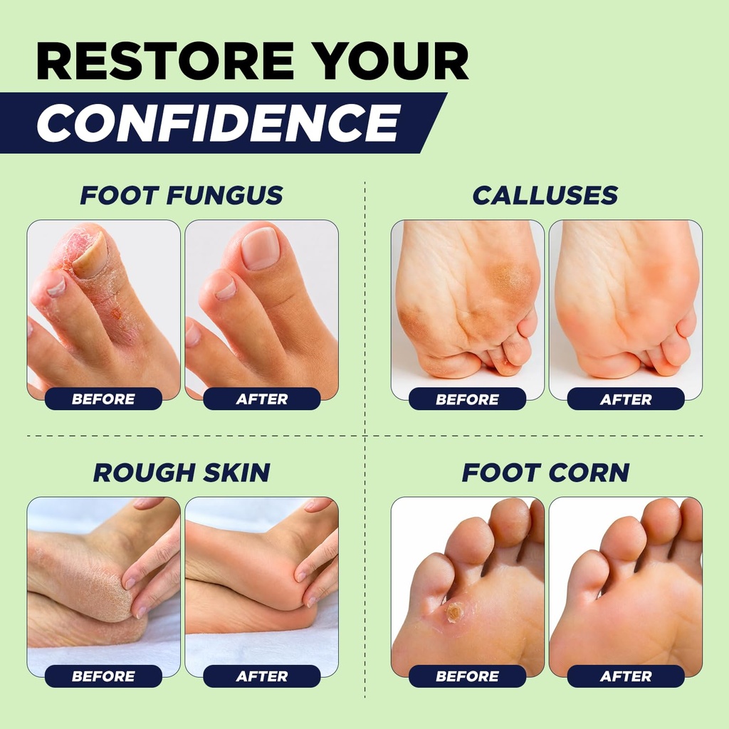 tea-tree-oil-foot-cream-for-dry-cracked--718oe418ZgL.jpg