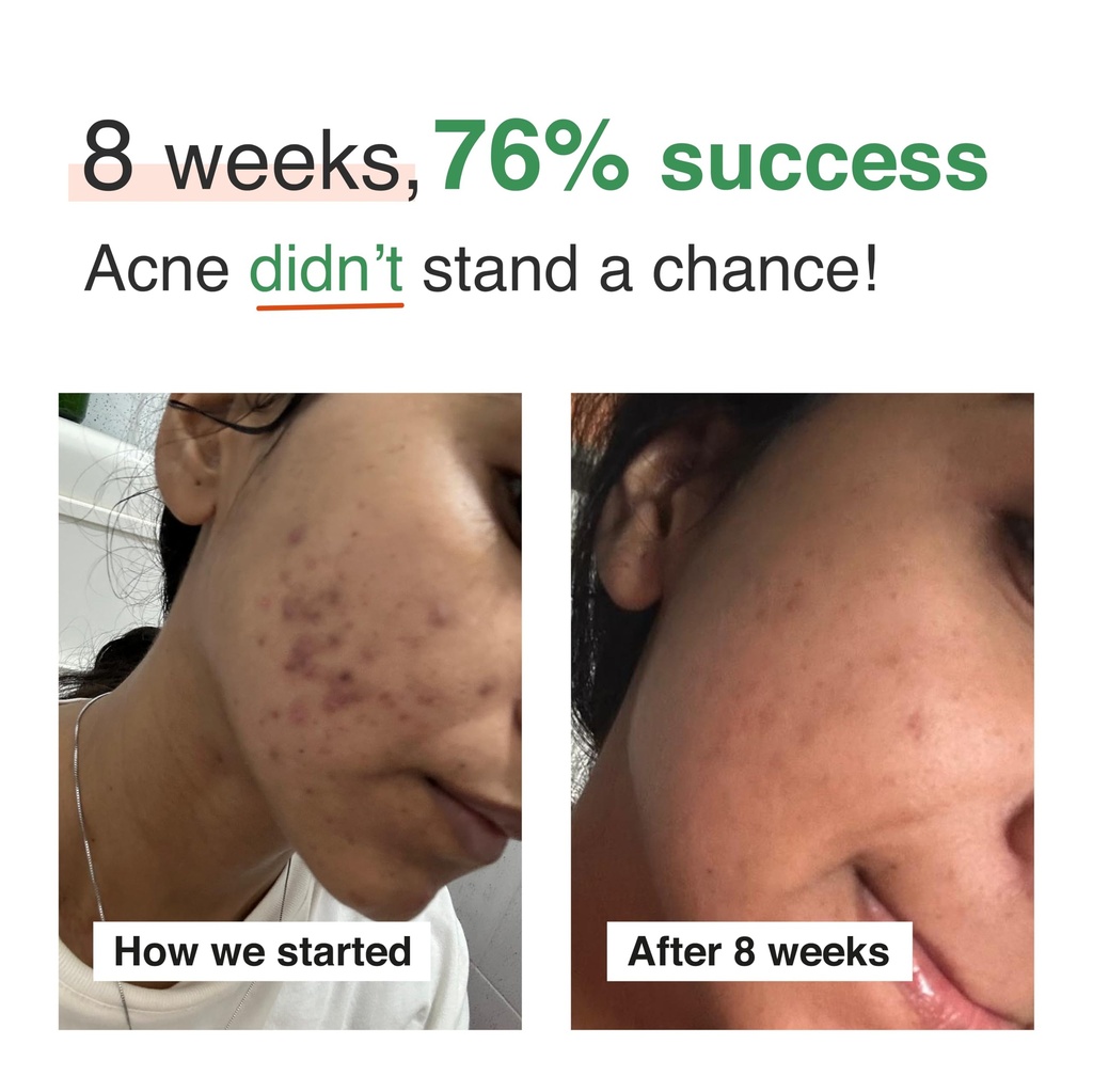 beyond-clear-skin-acne-supplement-for-wo-71DEhyt0AKL.jpg