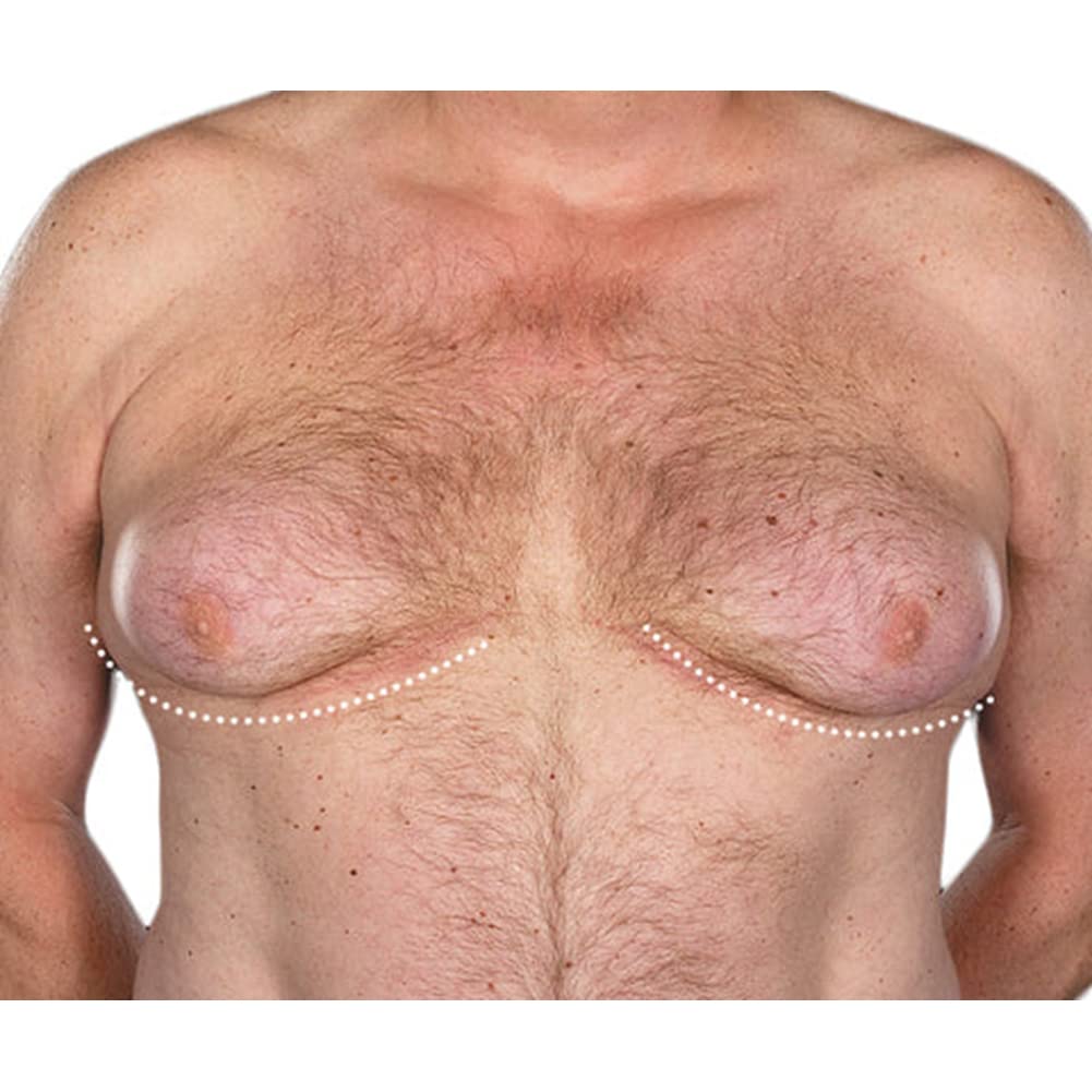 ikasus-powerful-gynecomastia-tightening--2.jpg