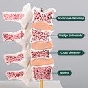 ultrassist-human-anatomy-osteoporosis-mo-3.jpg