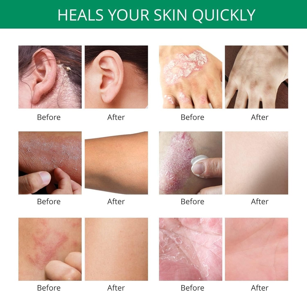 hermon-psoriasis-eczema-relief-cream-max-5.jpg