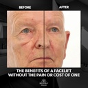 beverly-hills-mens-instant-facelift-and--3.jpg