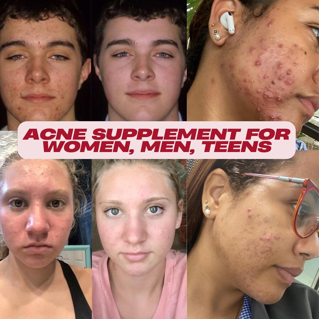 3-pack--vitamin-supplements-for-acne-tre-5.jpg