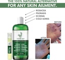 all-natural-eczema-treatment--psoriasis--2.jpg