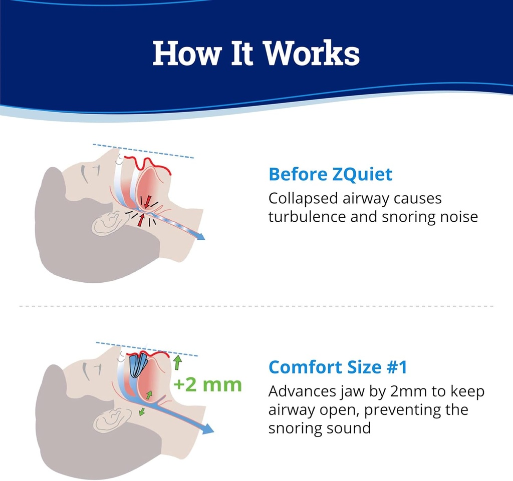 zquiet-anti-snoring-mouthpiece-solution--2.jpg