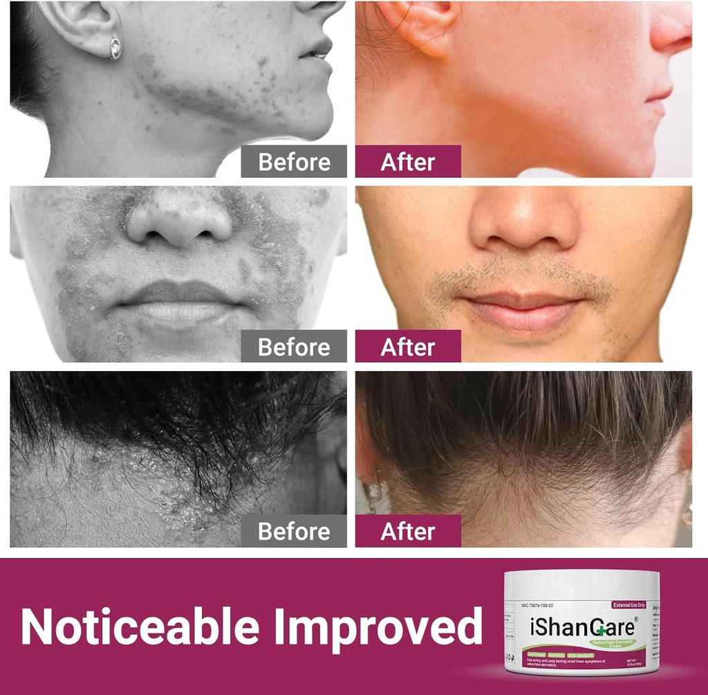 ishancare-seborrheic-dermatitis-cream-ma-6.jpg