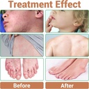 urticaria-cream-hives-relief-advanced-fo-5.jpg