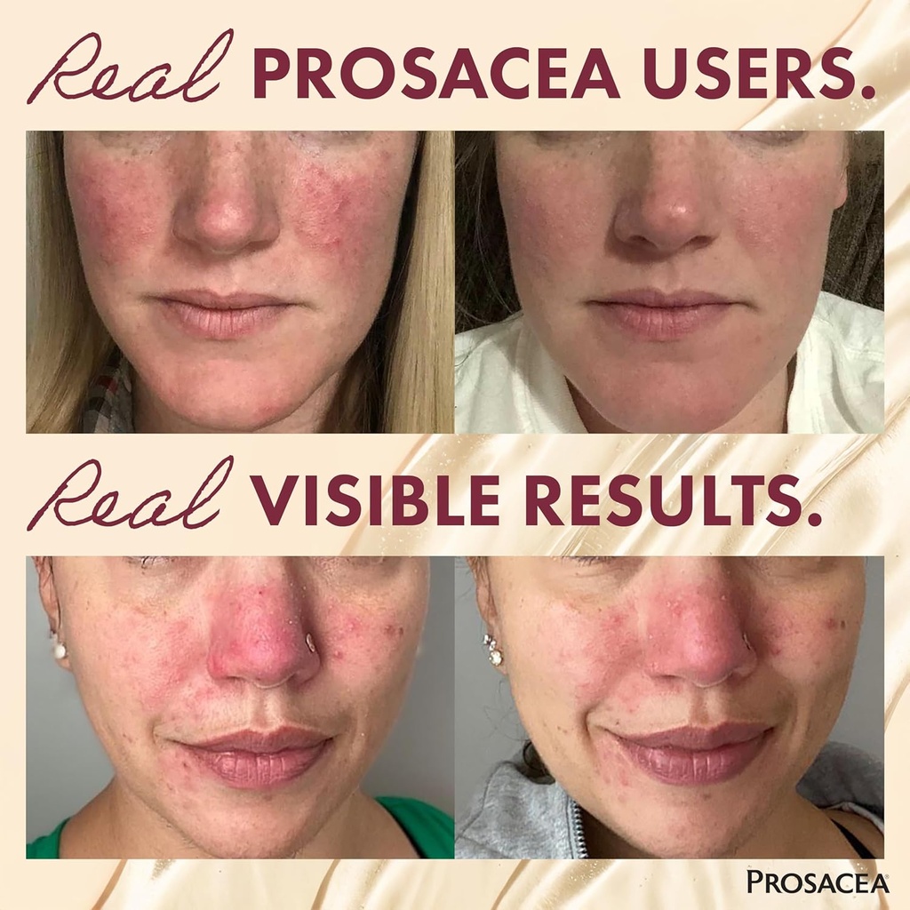 prosacea---medicated-rosacea-treatment-f-3.jpg