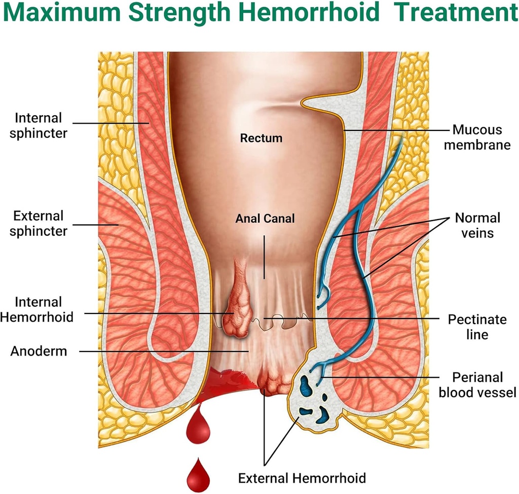 hemorrhoid-treatment-ointment-maximum-st-2.jpg