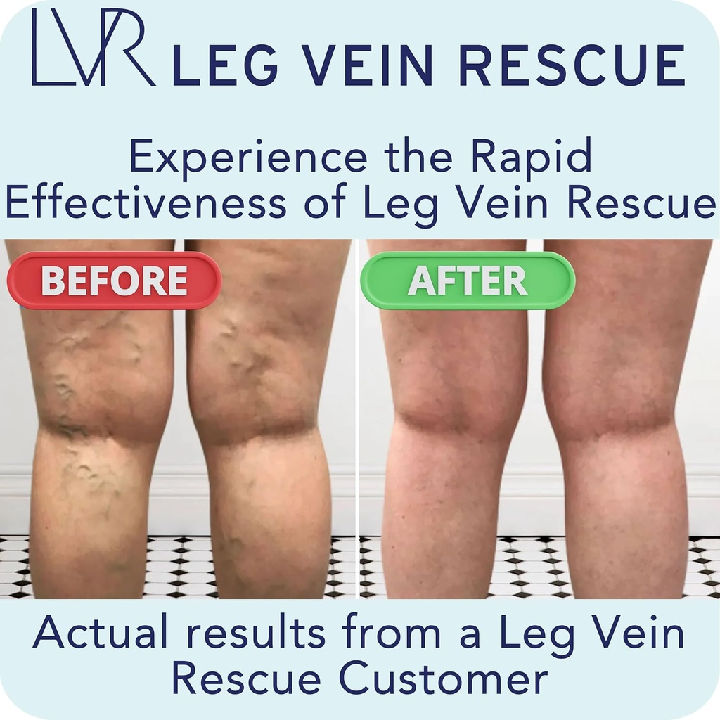 clinically-studied-diosmin-varicose-vein-3.jpg