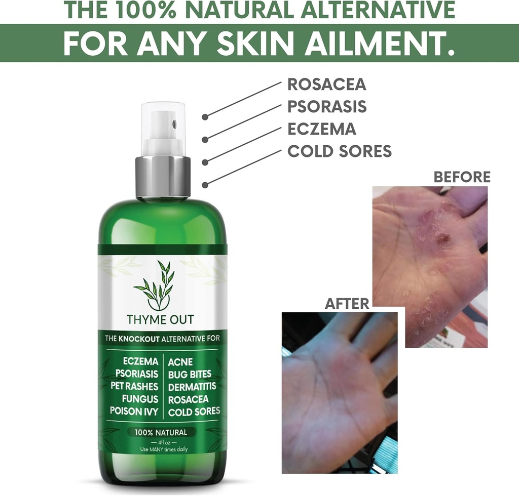 all-natural-eczema-treatment--psoriasis--2.jpg