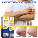 2-pcs-psoriaheal-bee-venom-psoriasis-tre-5.jpg