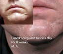 scarguard-invisible-brush-on-silicone-sh-5.jpg